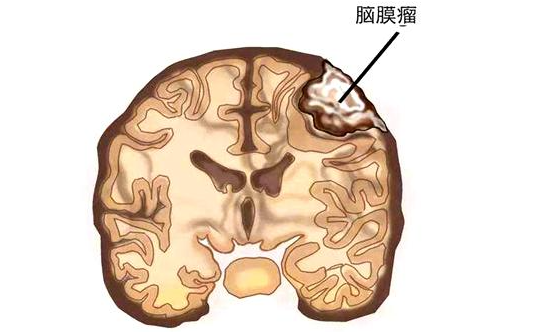 脑膜瘤位置图解图片