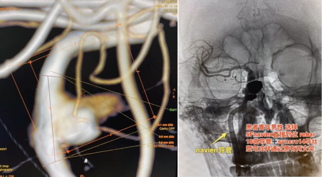 willis覆膜支架精准置入治疗复发颈内动脉瘤