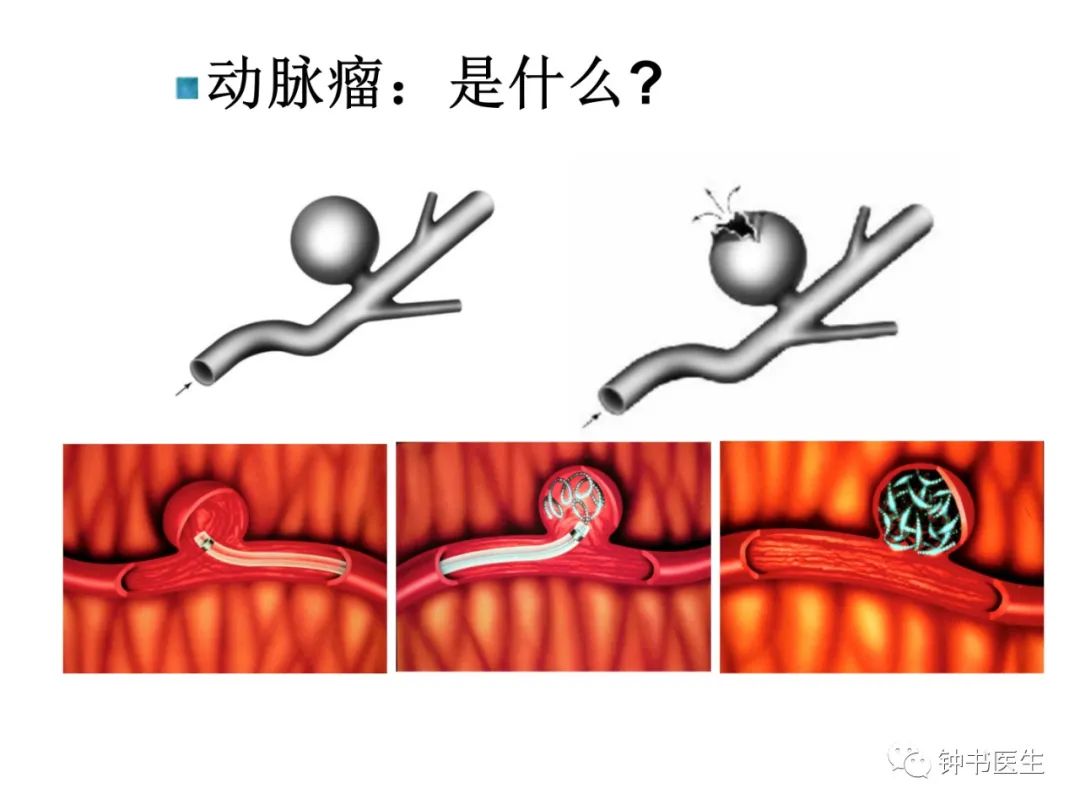 钟书教授专栏丨颅内动脉瘤概论 - 脑医汇