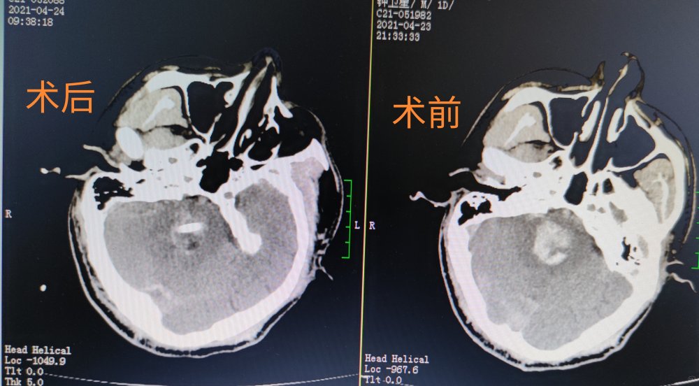 张凌云术前术后.jpg