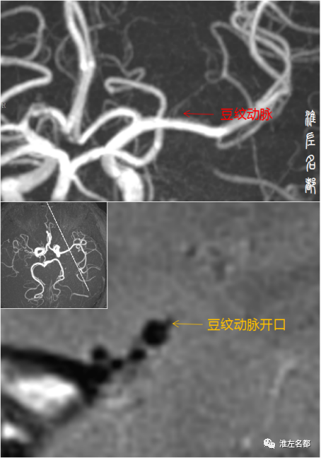 豆纹.png