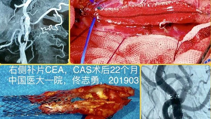 篩選的症狀性基底動脈重度狹窄或閉塞的患者提供了新的外科手術選項