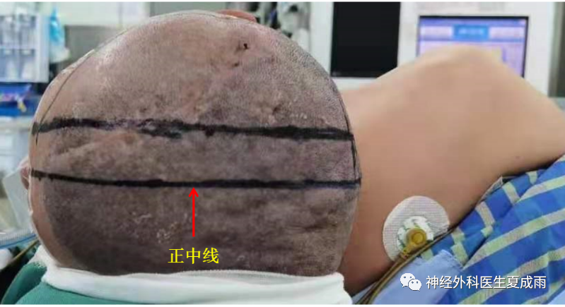 標記正中矢狀線:自前額部眉心至枕外粗隆作一條頭顱正中矢狀線(在病人