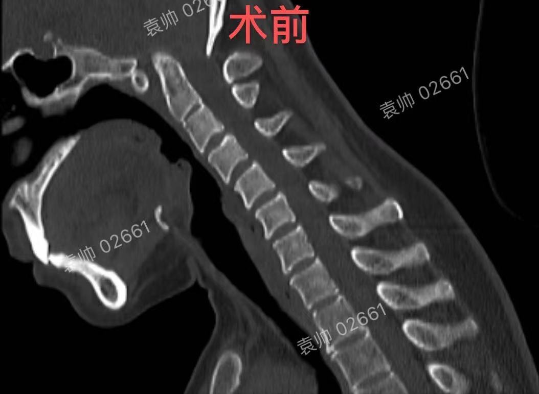 贺晓生教授小脑扁桃体下疝畸形（Chiari畸形）的手术治疗案例_脊髓