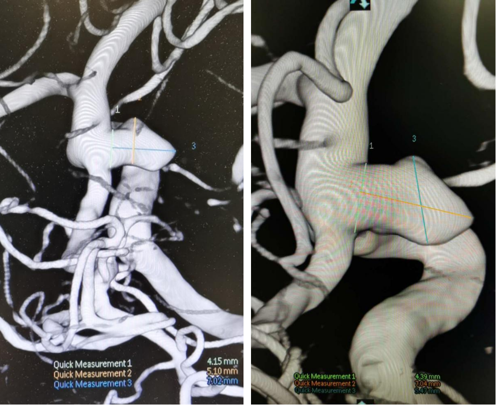 enterprise支架神龙摆尾栓塞胚胎型后交通宽颈动脉瘤