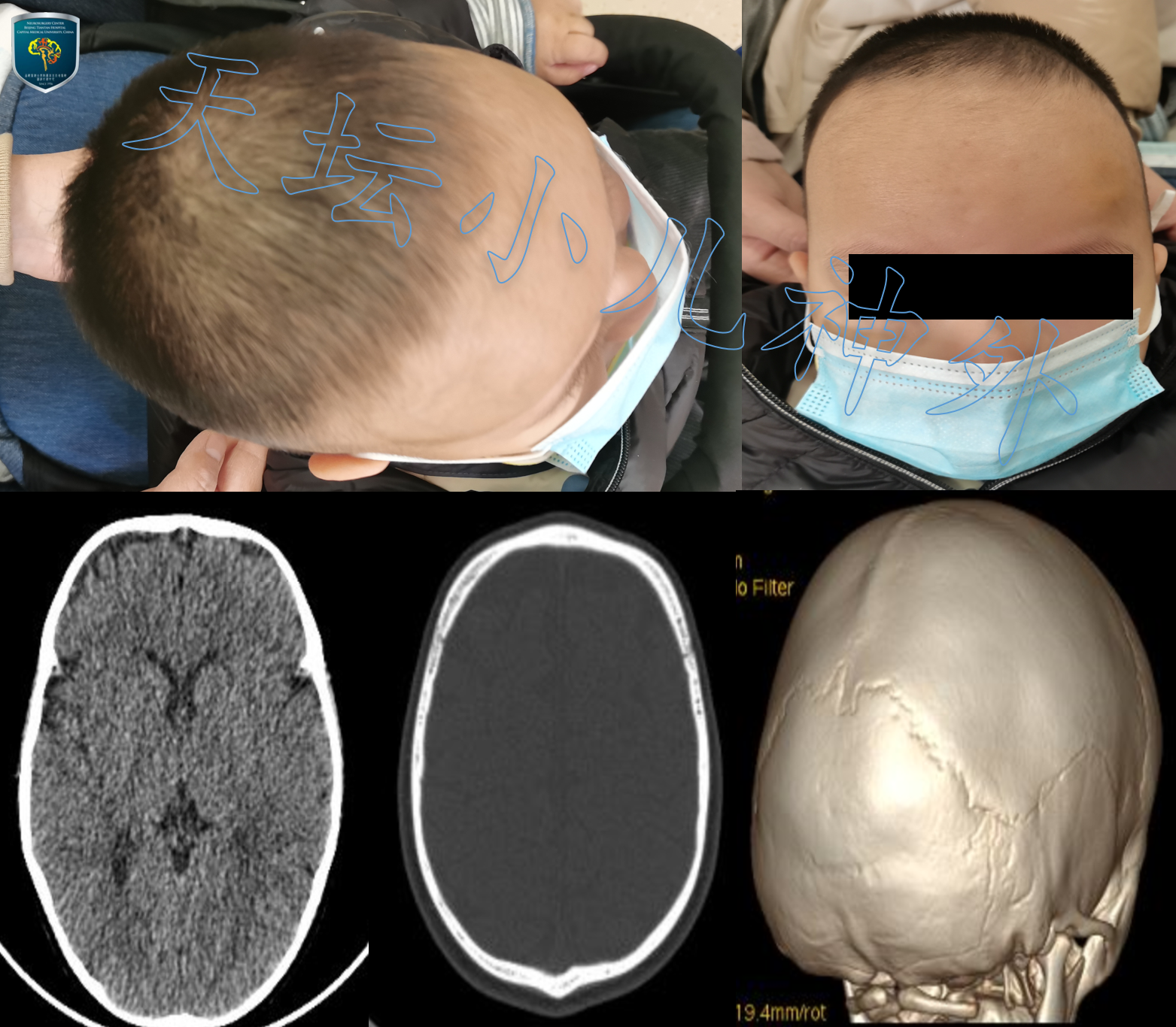 宫剑教授病例分享|婴幼儿颅骨生长性骨折的治疗策略 - 脑医汇 - 神外资讯 - 神介资讯