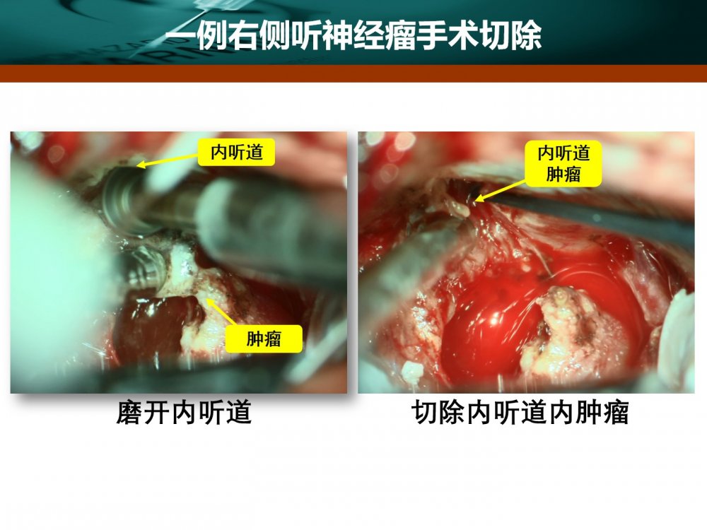 王拓教授團隊一例右側聽神經瘤手術切除