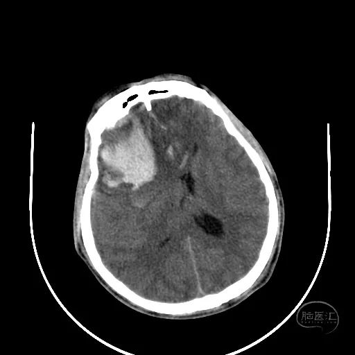 监测有道丨一例特重度颅脑损伤的救治思考颅脑创伤神经重症周刊第225