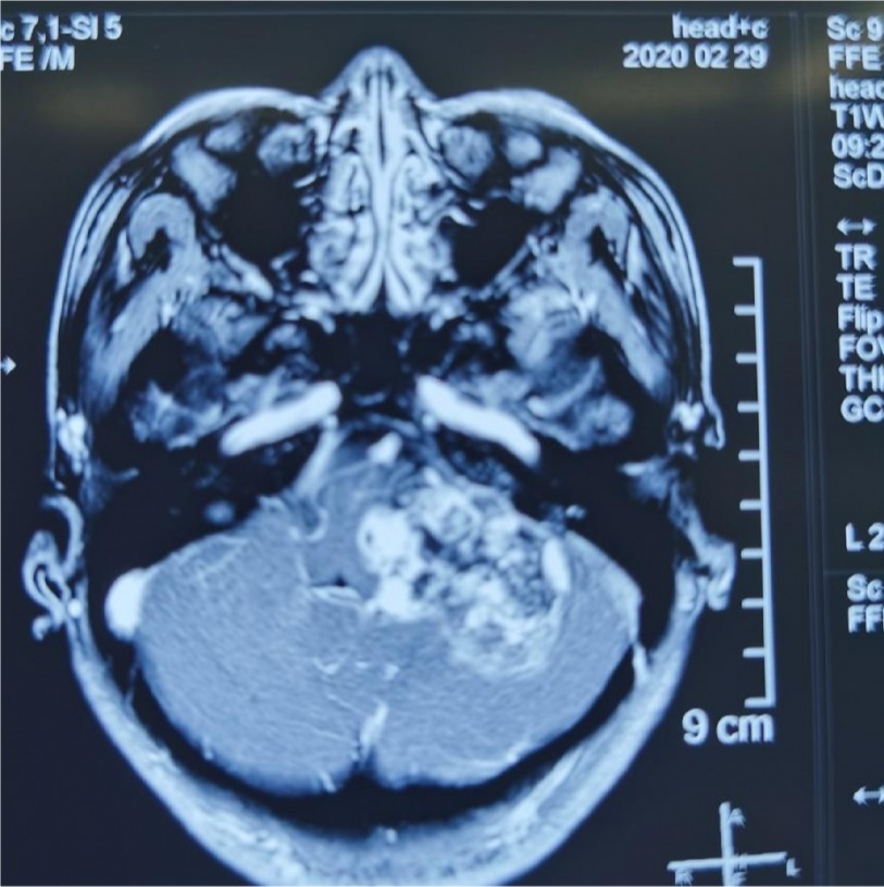 刘振林教授颈静脉孔区软骨肉瘤1例