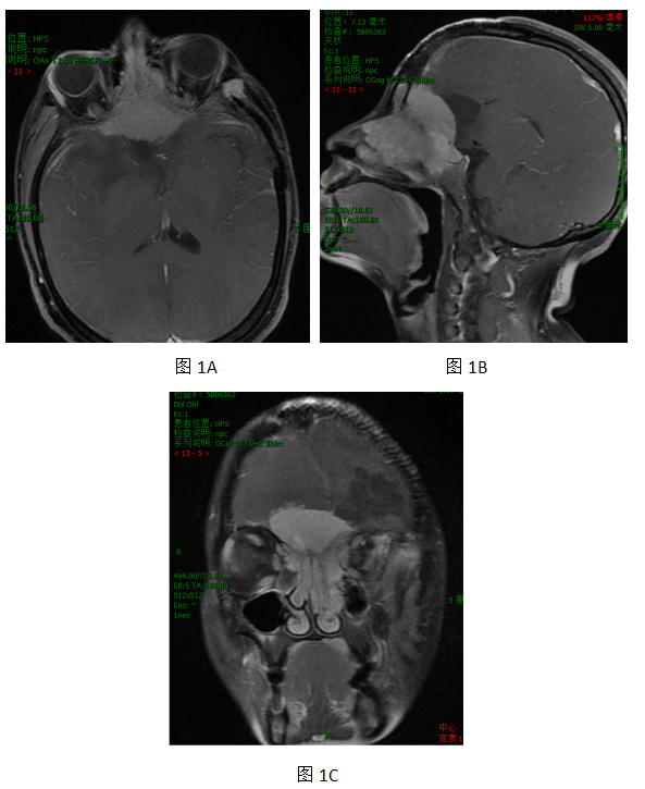 頭顱mri示左側額部呈術後改變,局部顱骨缺損,可見網狀信號影;前顱窩不