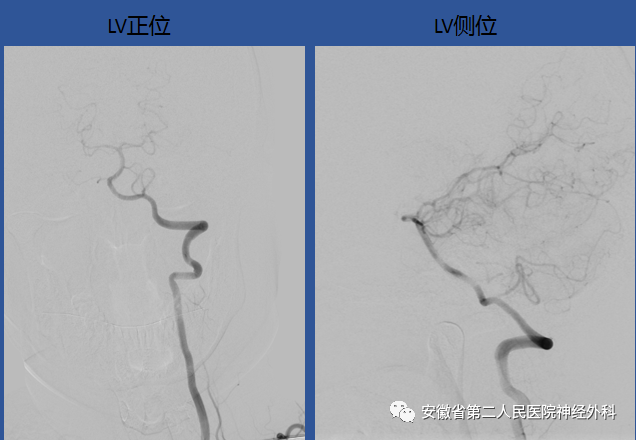 伴有意識障礙及噁心感,我院頭顱ct示蛛網膜下腔出血(前縱裂池為著)