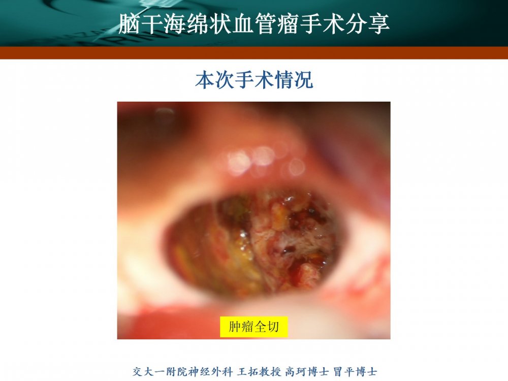 王拓教授团队:脑干海绵状血管瘤手术分享 