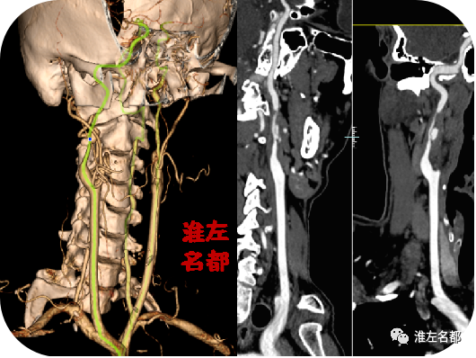 颅脑cta:所见颅内脑动脉未及异常.△颅脑ct平扫:未见明确异常.