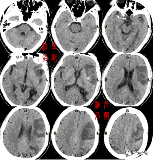 脑梗塞ct图片解读图片