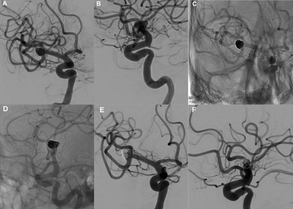 neuroformatlas支架治疗大脑中动脉瘤效果atlaside试验1年结果