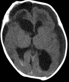 Post-op CT 1.jpg