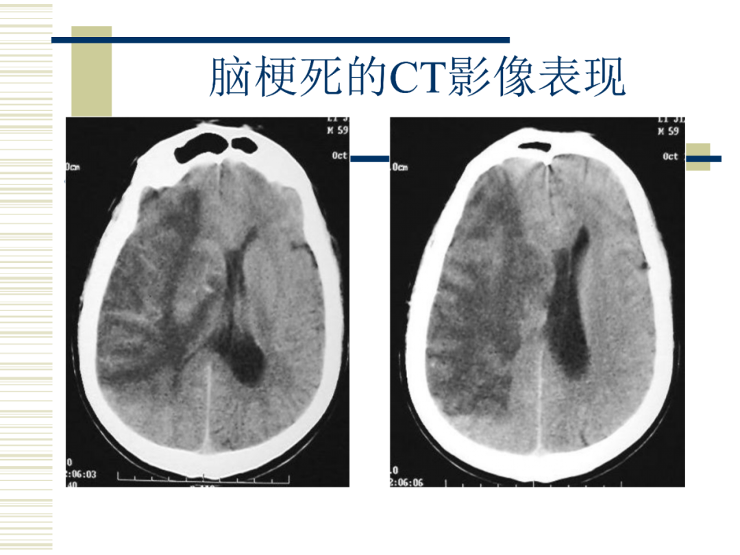 局部脑沟增宽,脑室扩大边界清楚的低密度,似脑脊液密度陈旧梗塞2