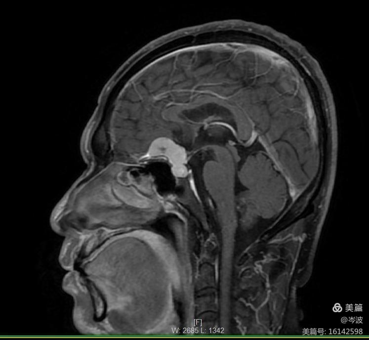 鞍结节和蝶骨平台mr增强提示肿瘤血供丰富t2像提示肿瘤质地稍韧,大脑