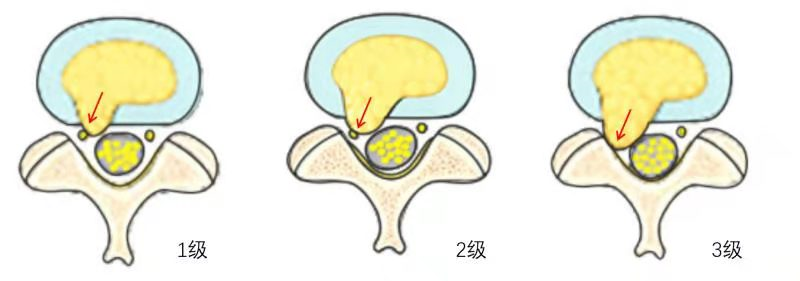 双侧神经根受压图片