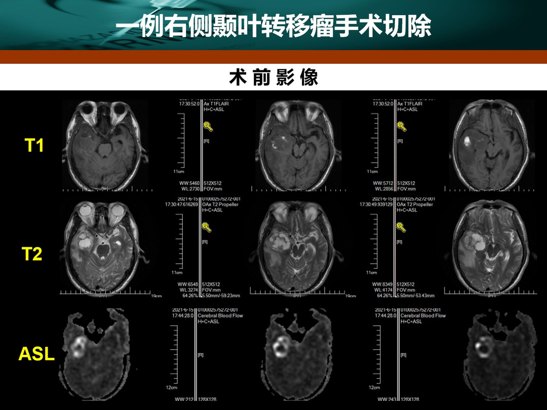 王拓教授团队：一例右侧颞叶转移瘤手术切除 - 脑医汇
