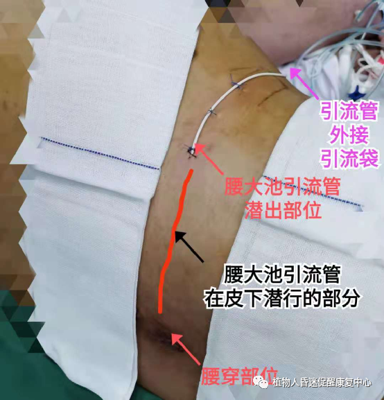 图6:腰大池外引流装置,一面引流脑脊液,一面抗菌进行治疗.