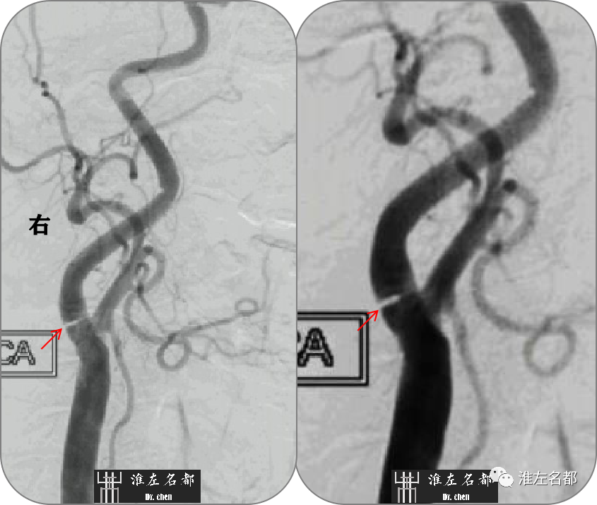 神经血管影像速阅(67)：颈动脉蹼—MRA、CTA、DSA和管壁MRI - 脑医汇 - 神外资讯 - 神介资讯