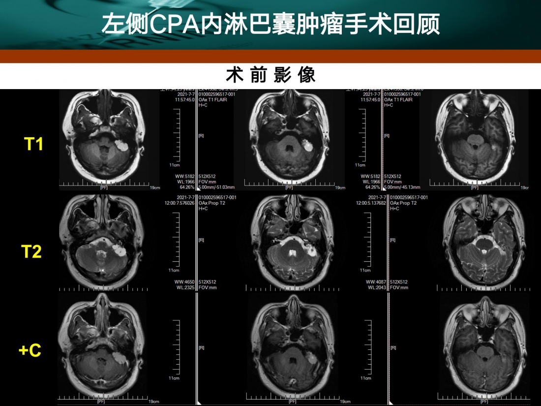 贺晓生教授小脑幕上下骑跨脑膜瘤的外科切除手术案例 - 微医（挂号网）