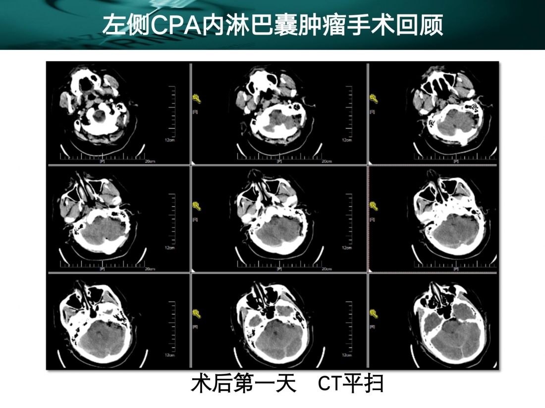 病例播报  左侧CPA区内淋巴囊肿瘤_08.jpg