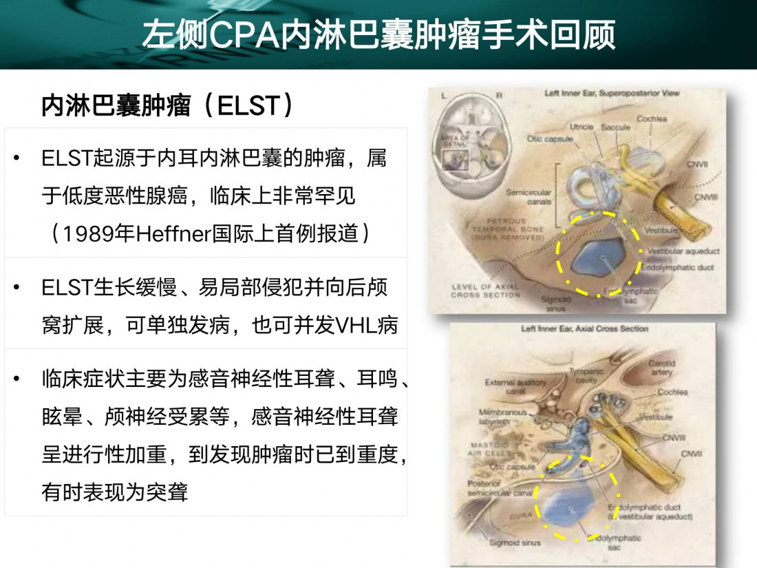 病例播报  左侧CPA区内淋巴囊肿瘤_11.jpg