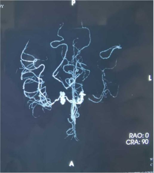 劉振林教授左側顳淺動脈大腦中動脈搭橋術右側後交通動脈瘤栓塞術1例