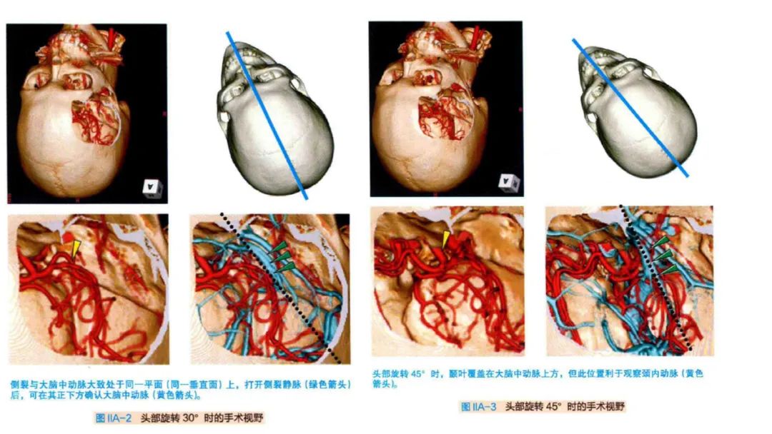 大脑中动脉动脉瘤开颅夹闭手术基本技巧