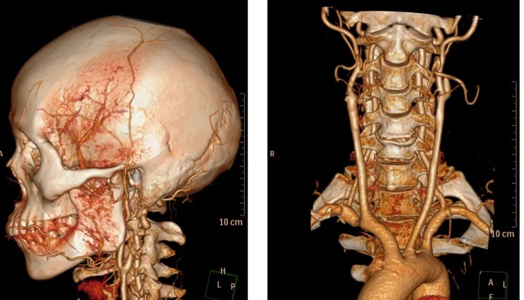 颈动脉瘤位置图片图片