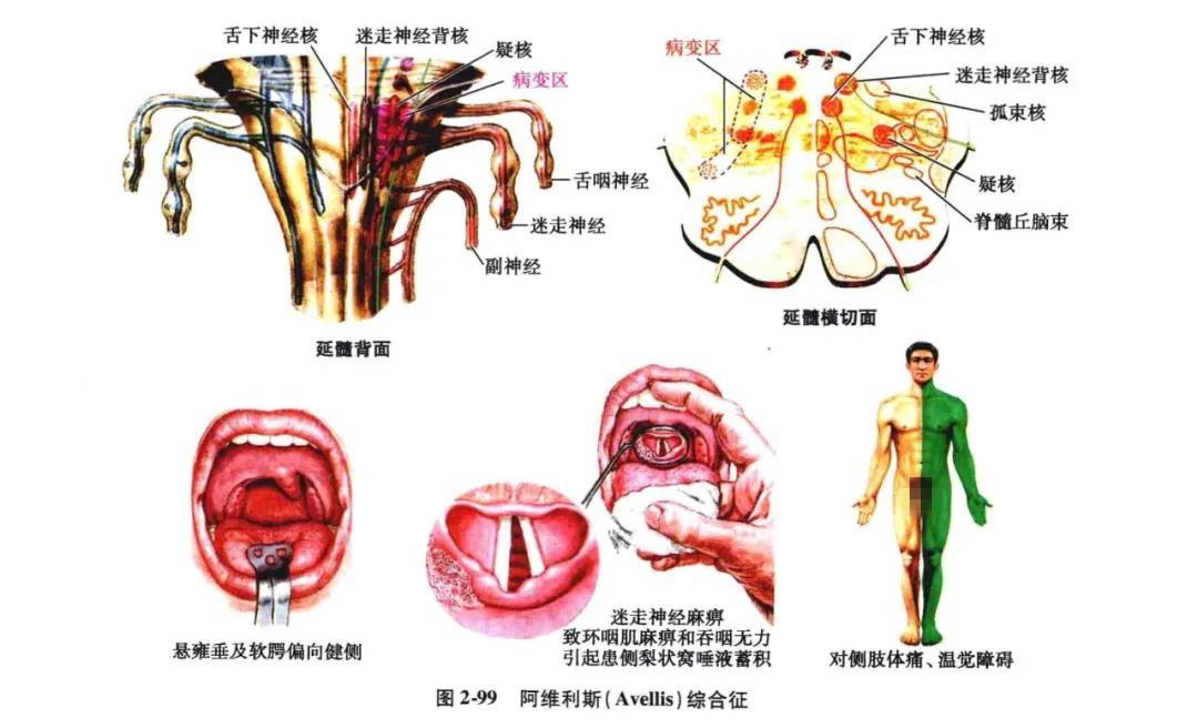 資訊文章 正文(4)舌咽,迷走,脊髓丘腦束綜合徵(阿維利斯,avellis 綜合