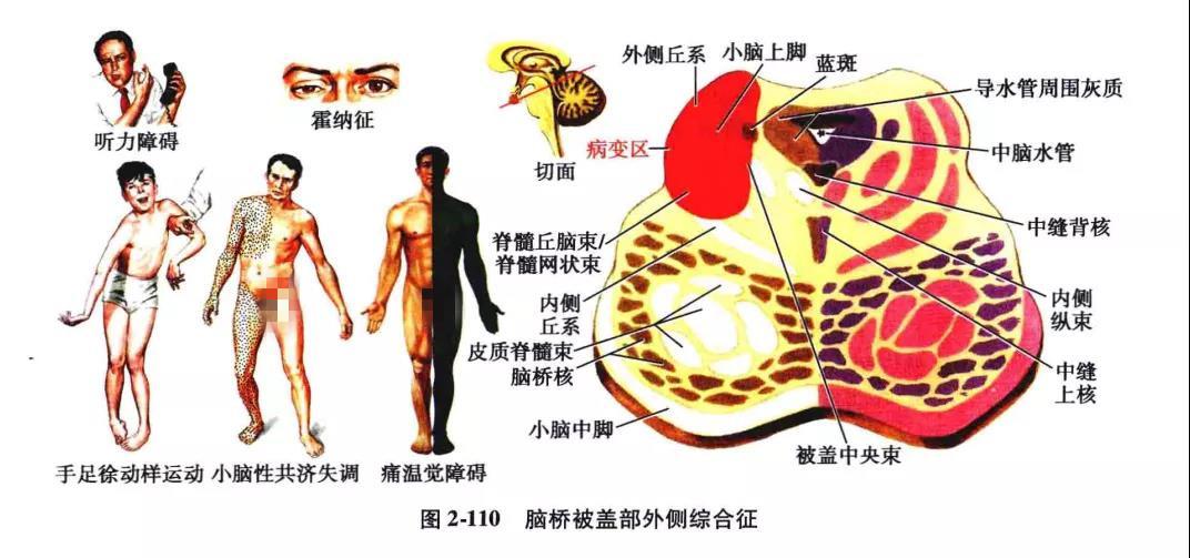 脑干生理,解剖,病损定位【人手一册】