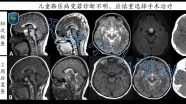 天坛小儿神外宫剑教授访谈：儿童视路胶质瘤（OPG）的天坛诊疗规范