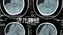 幼儿侧裂蛛网膜囊肿破裂硬膜下积液，治疗方案：内镜造瘘。2岁，男，头部轻微外伤后呕吐。19年病例。