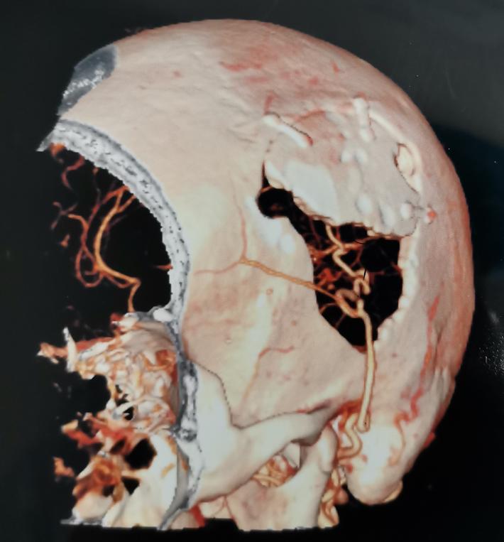 sta-mca搭桥 硬膜反转 颞肌贴敷术治疗烟雾病