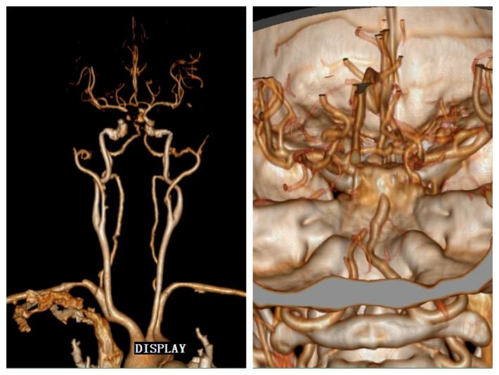 急性基底动脉闭塞取栓一例