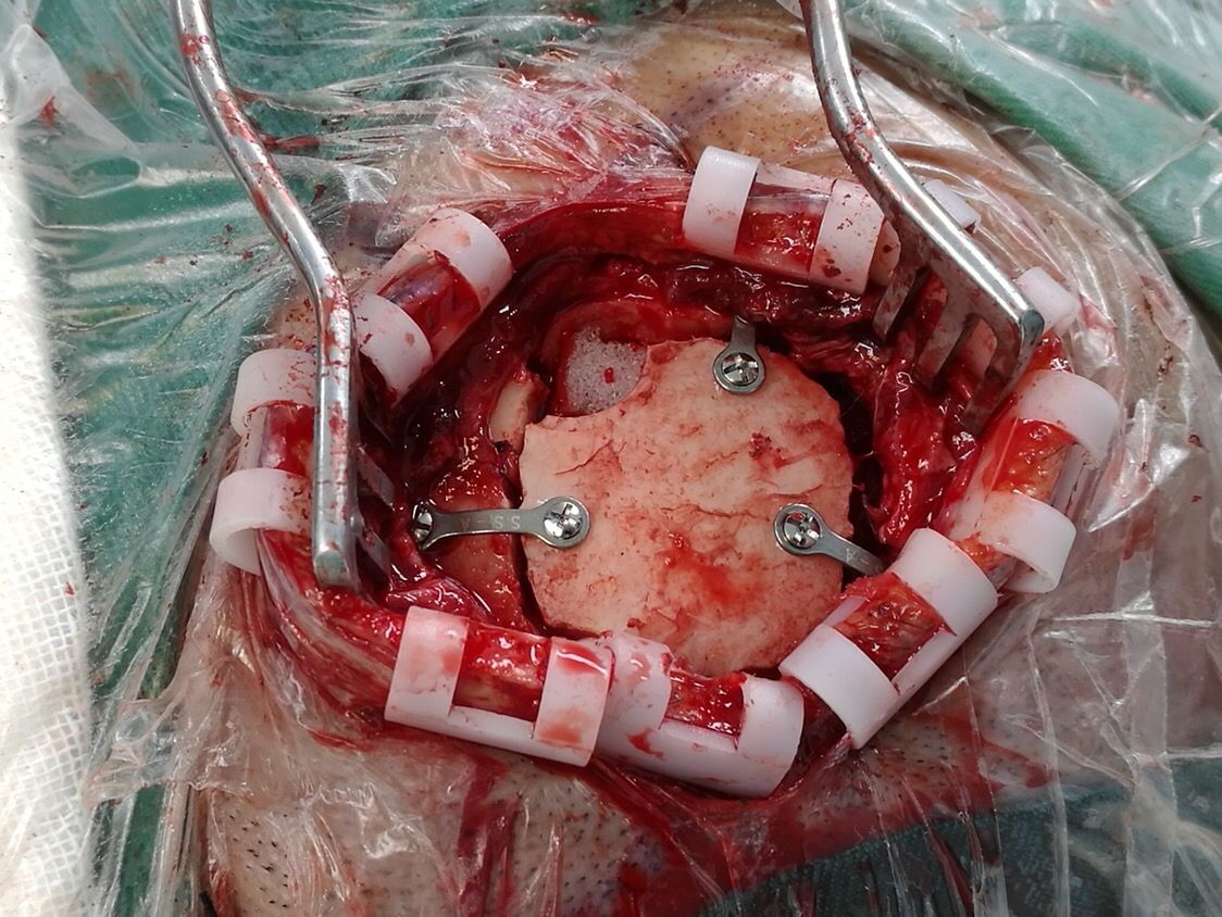 神经内镜下经颞小骨窗慢性硬膜下血肿清除术 山西省人民医院神经外科