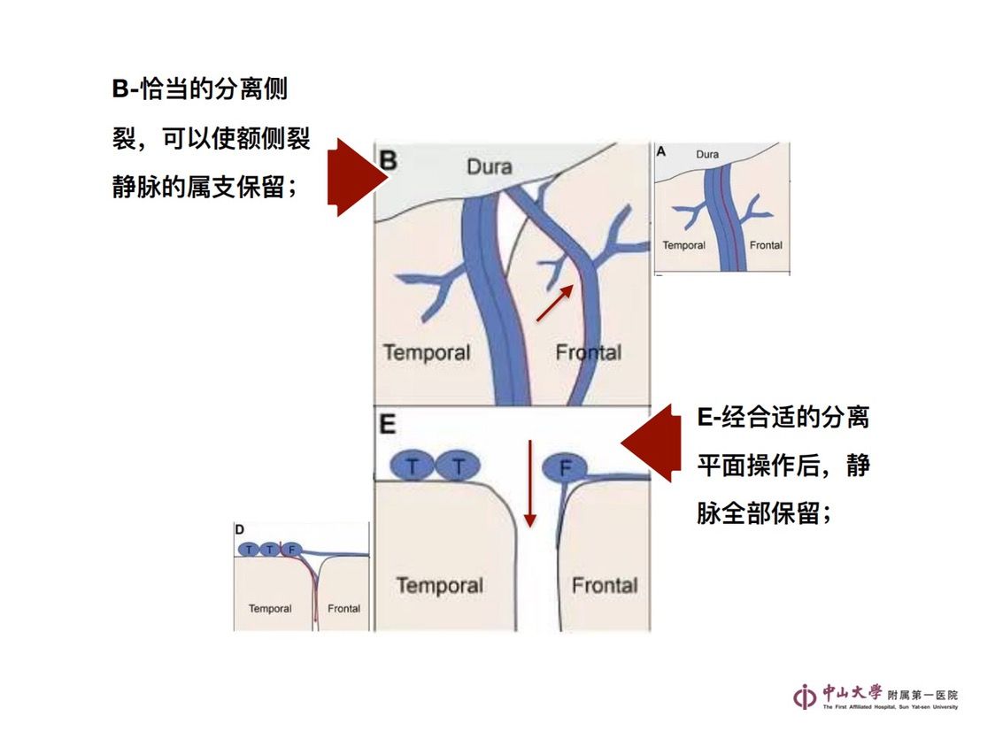翼点入路-外侧裂静脉分离 - 脑医汇