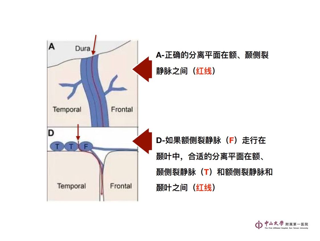 翼点入路-外侧裂静脉分离 - 脑医汇