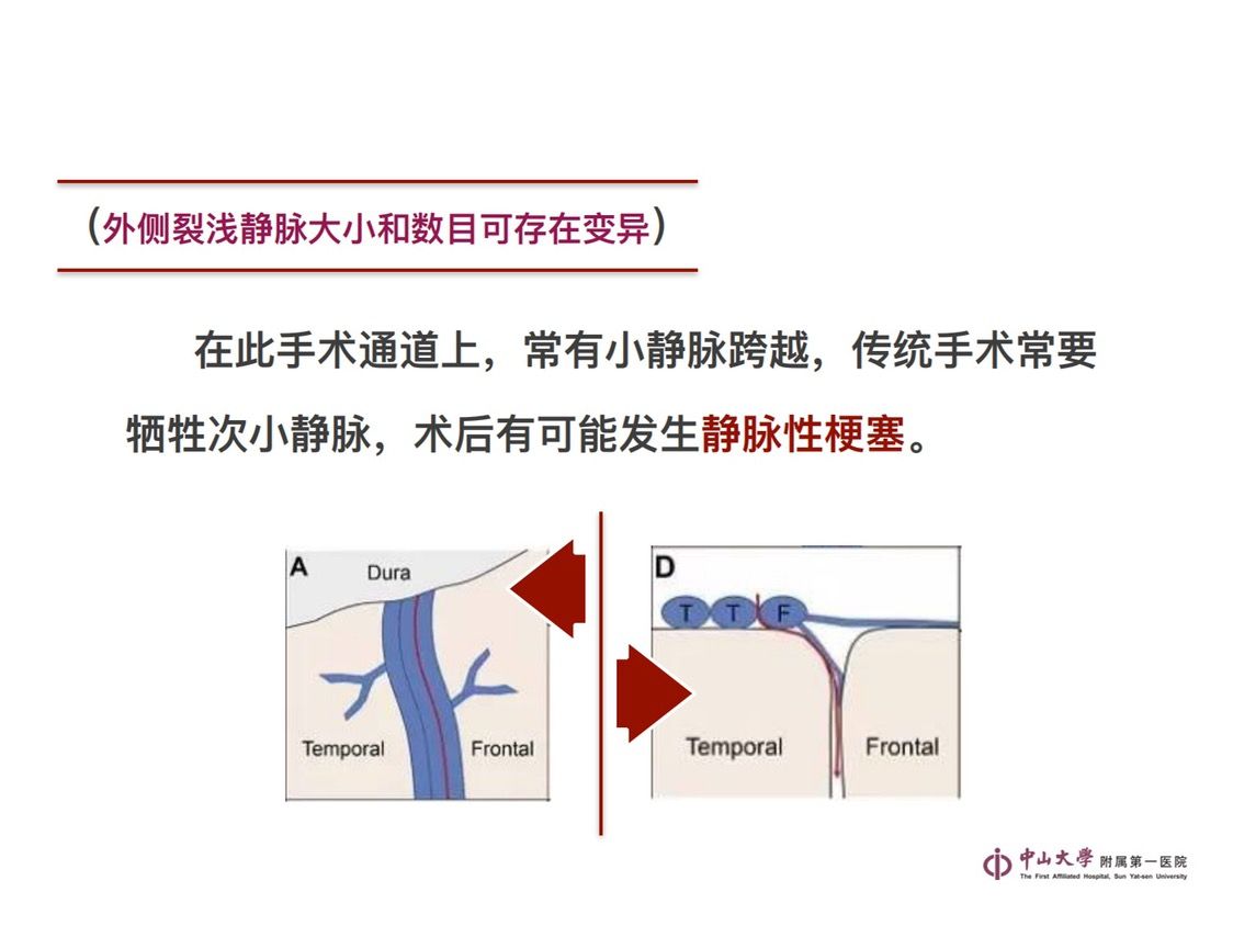 翼点入路-外侧裂静脉分离 - 脑医汇