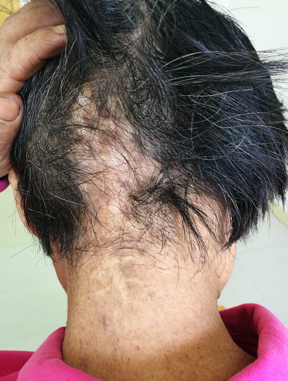 术后病理结果:非典型性细胞型蓝痣手术切除标本及标本切面观术毕刀口