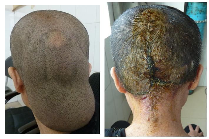 术后病理结果:非典型性细胞型蓝痣手术切除标本及标本切面观术毕刀口