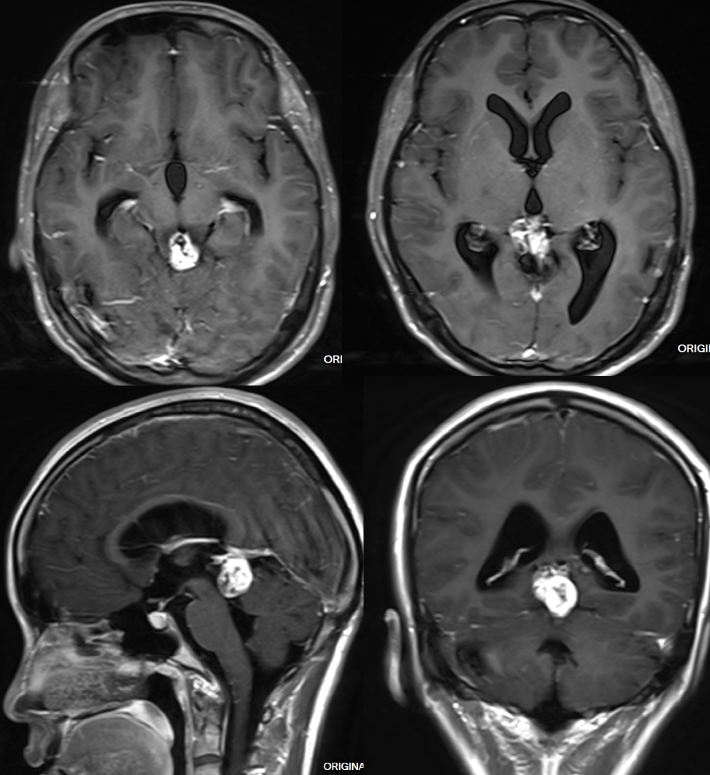 松果体层面MRI图图片