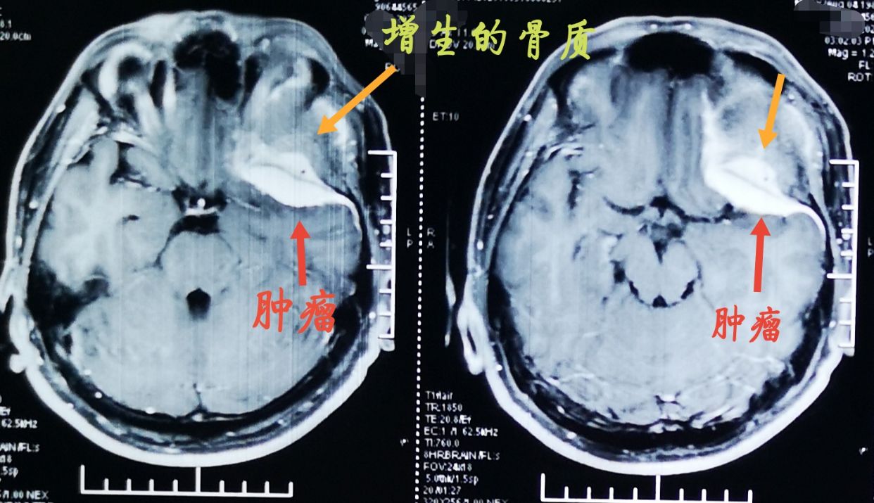 鑽孔四枚,從關鍵孔處,用小磨鑽向眶和蝶骨嵴方向磨除增生的骨質.