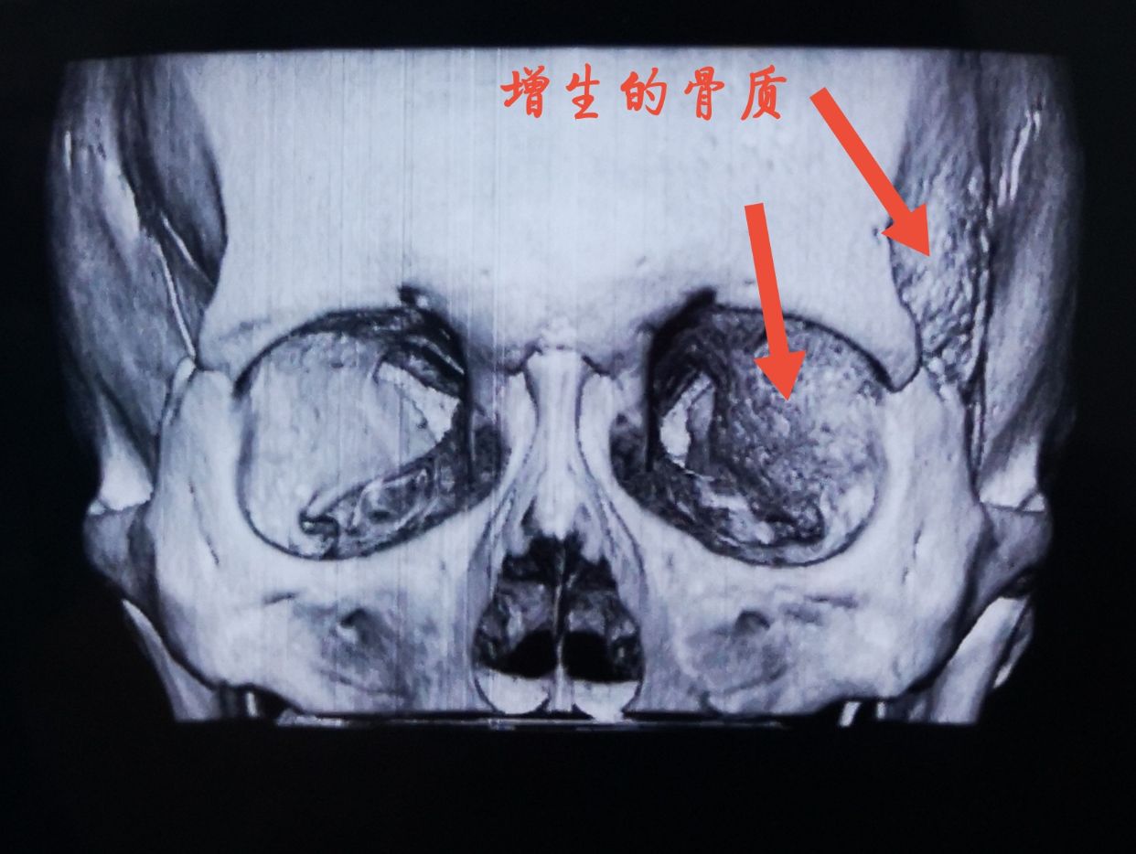 鑽孔四枚,從關鍵孔處,用小磨鑽向眶和蝶骨嵴方向磨除增生的骨質.