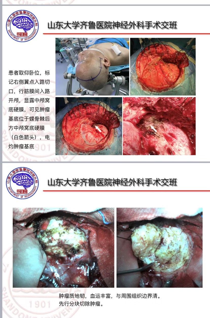 脑叶白质切除术图片