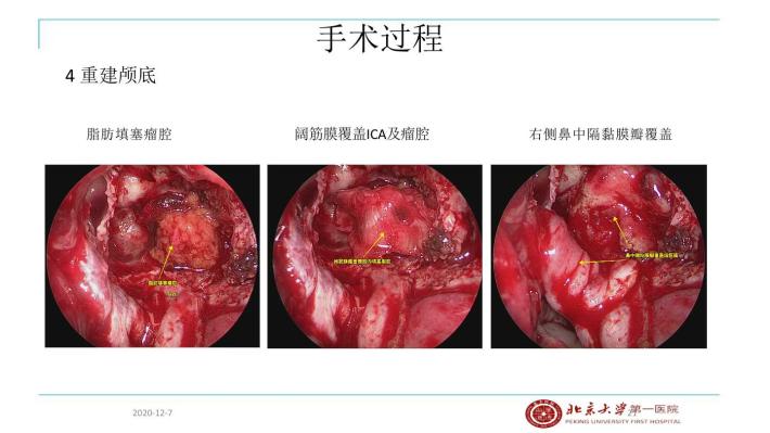 内镜经蝶窦翼突入路切除meckel腔三叉神经鞘瘤