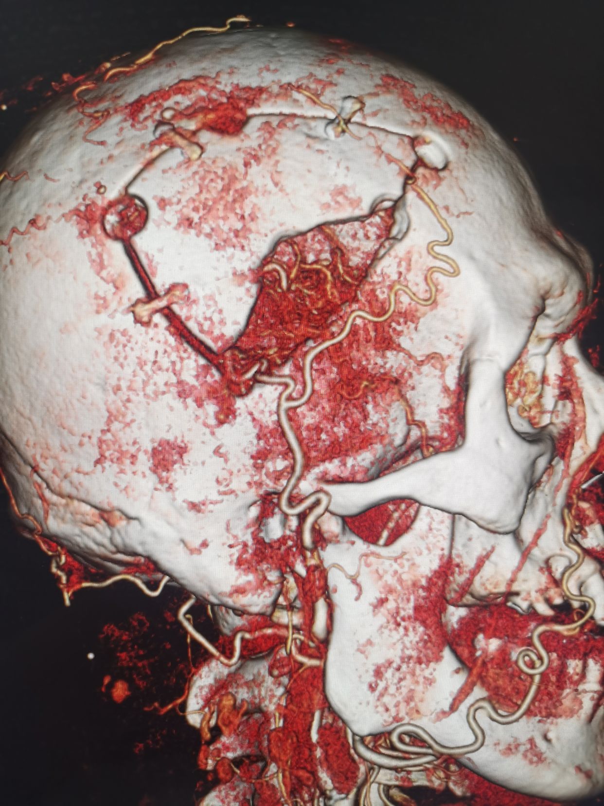 一例出血性烟雾病stamcabypass颞肌贴敷术
